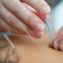 Acupuncture near me: find the best acupuncturists in your area
